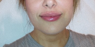 Singfiller Derm  Filler 5 x 2 ml - 3