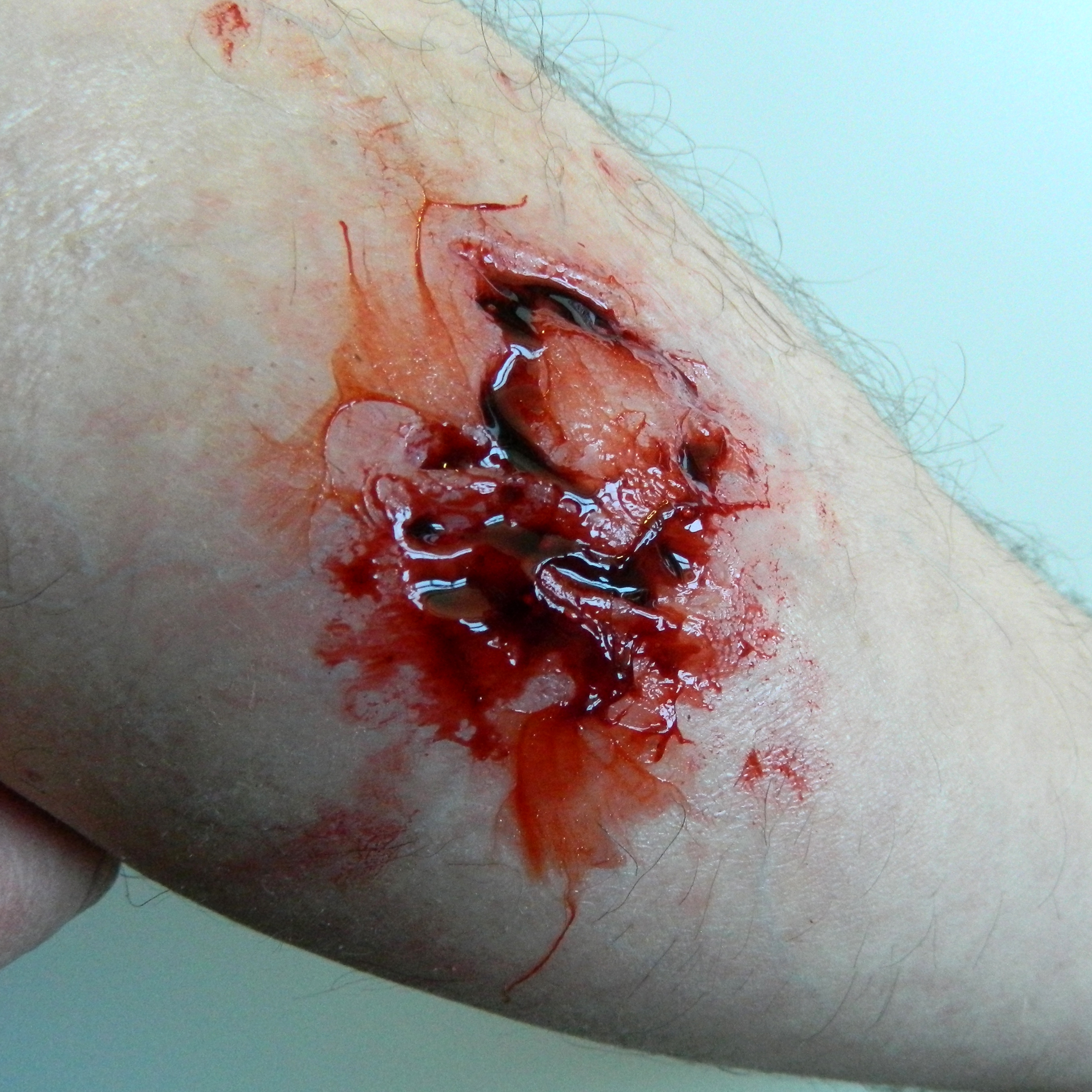 Flatmould Form 012 -&nbsp;Rivsår / Krosskada / Laceration  - 4