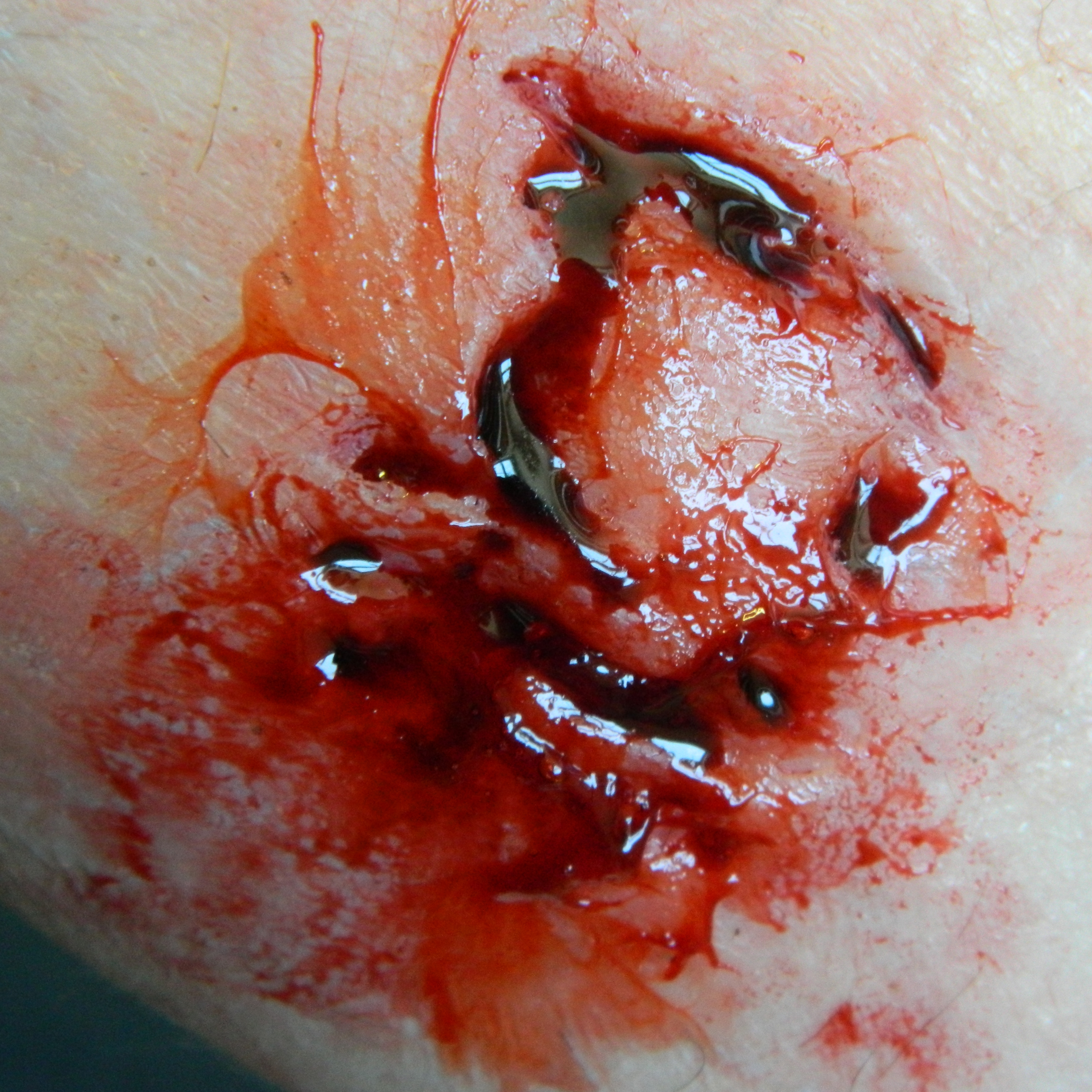 Flatmould Form 012 -&nbsp;Rivsår / Krosskada / Laceration  - 5