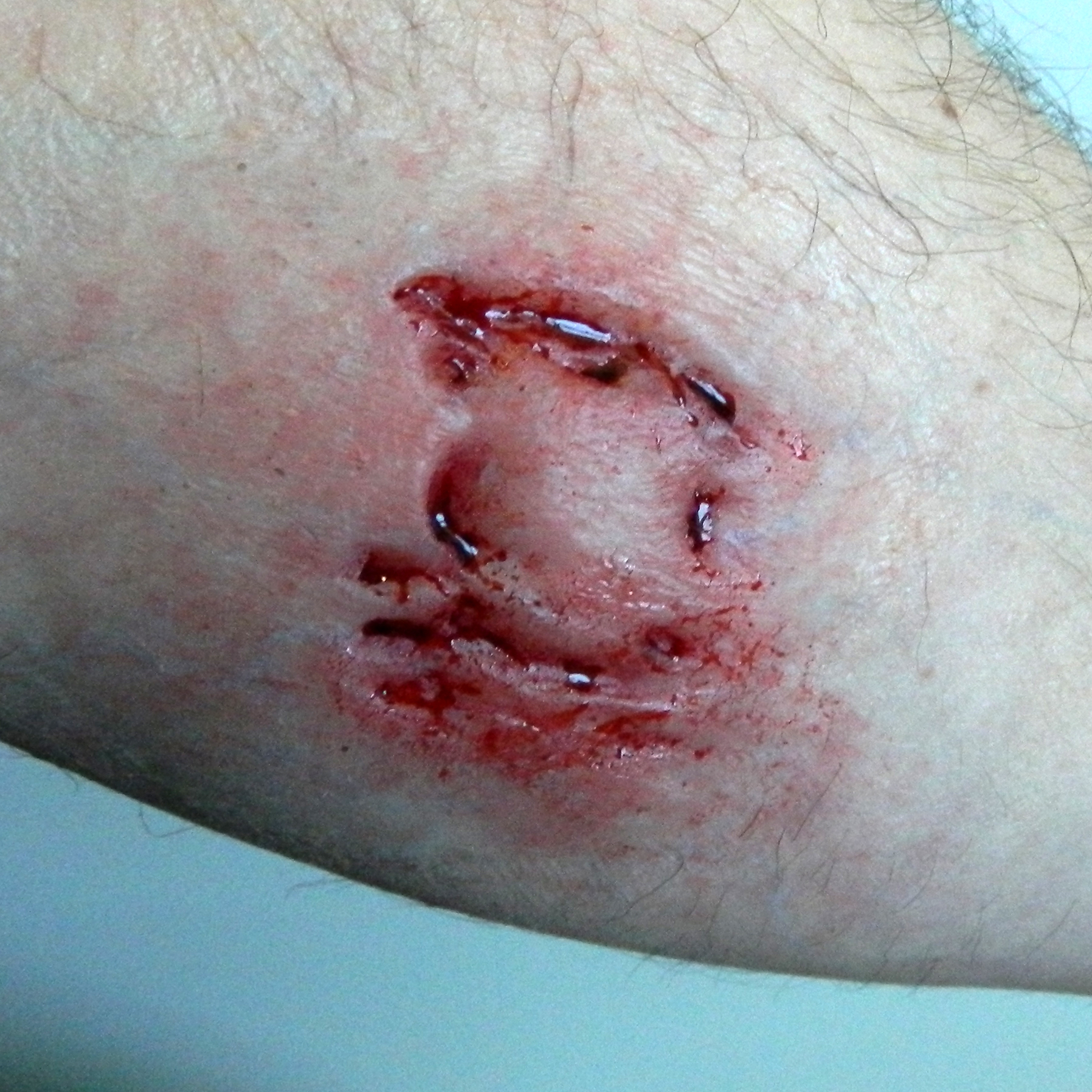 Flatmould Form 012 -&nbsp;Rivsår / Krosskada / Laceration  - 7