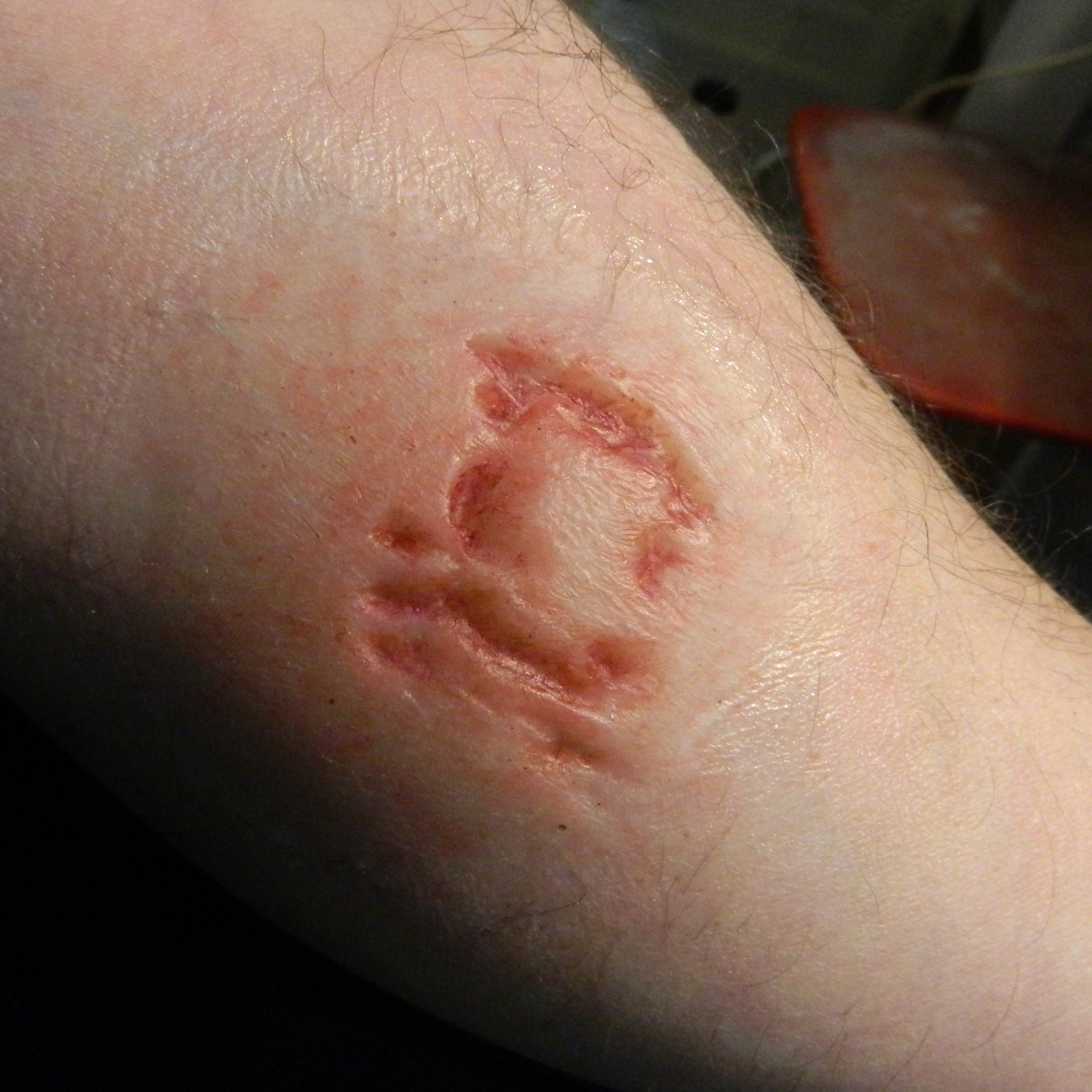 Flatmould Form 012 -&nbsp;Rivsår / Krosskada / Laceration  - 6