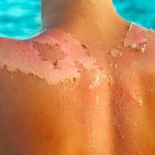 Sunburn Simulation 100 ml - 3