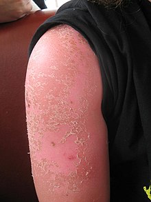 Sunburn Simulation 100 ml - 4