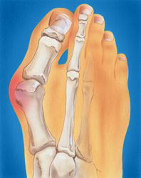 Deramed hallux valgus tåskillere 2 stk. - 3