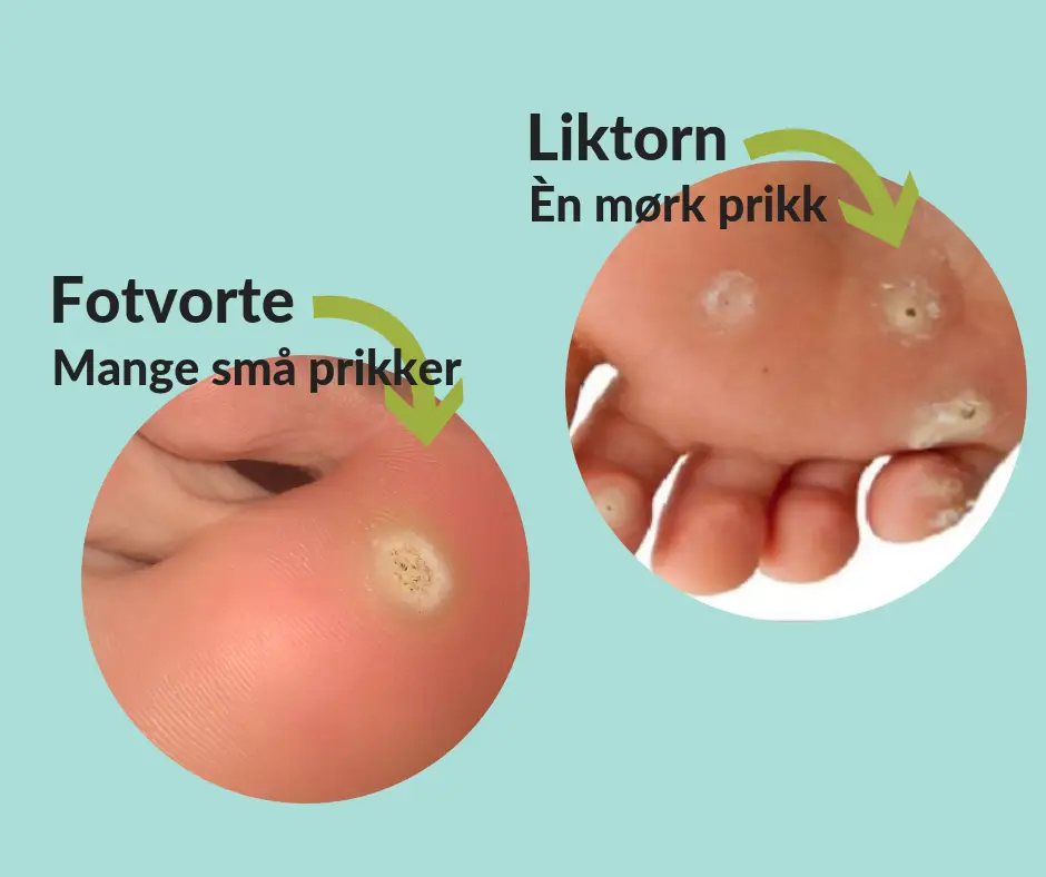 Vond hard hud under foten | Behandling og kjerringråd for fotforhardninger  - MedicOnline.no