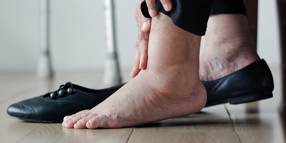 Svullna Anklar Orsak Tips Vid Behandling Av Svullen Ankel Mediconline