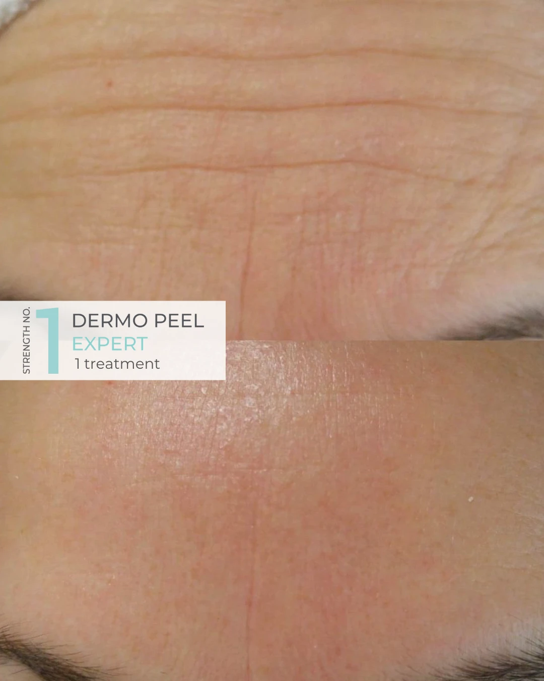 Dermo Peel Expert Kit Strength nr1 - 2
