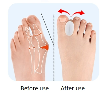 Hallux Valgus tåskiller, 6-pakk - 12