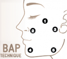 Super Filler Bella Hyaluronic Acid Injectable 1 x 5 ml