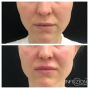 Infuzion + Peel & Glow - 2