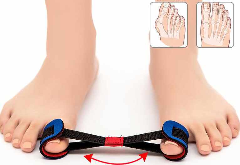Hallux Valgus - Tåstretchare - 4