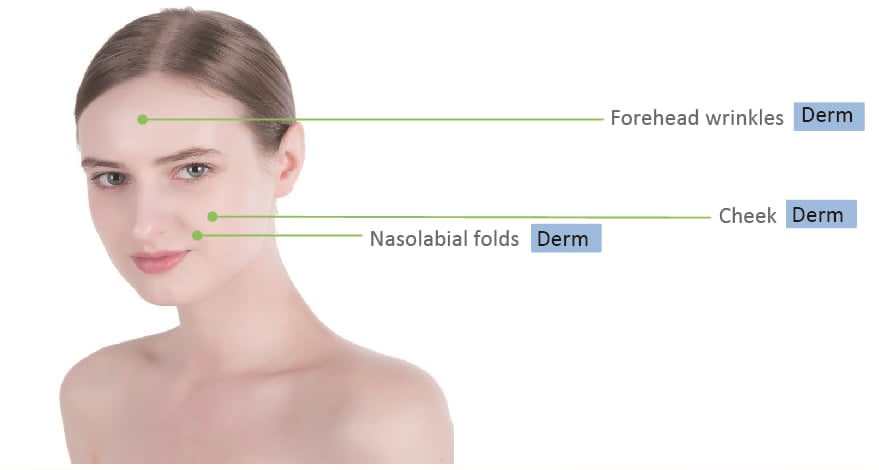 Singfiller Derm 1 x 2 ml  - 3