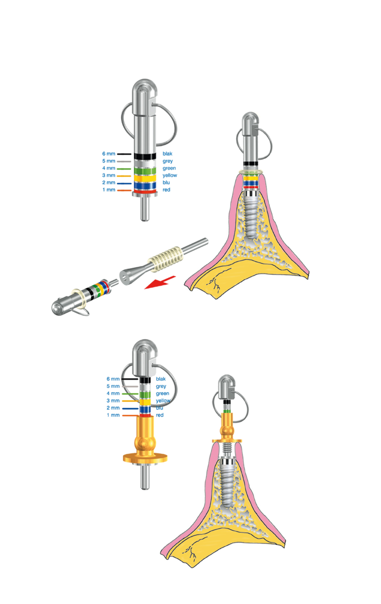 Gingiva height measuring kit - 2