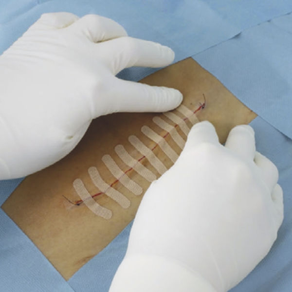 Leukoplast Wound Closure Strip - 5
