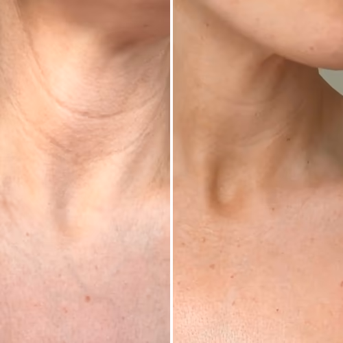 Currentbody Skin LED Neck and Dec Perfector: Series 2 - 5