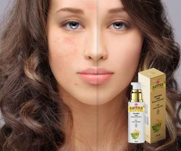 Anti - Pimple Cream 50ml, Sattva Ayurveda - 2