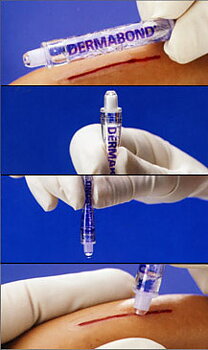 Dermabond Sårlim
