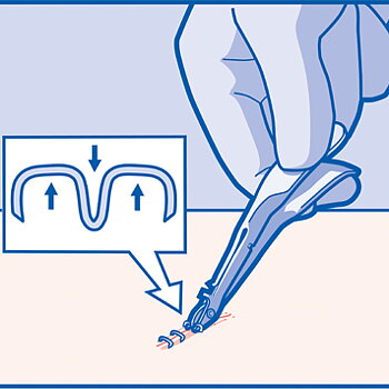 StapleRemover