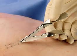 StapleRemover