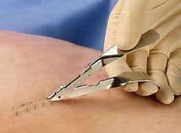StapleRemover