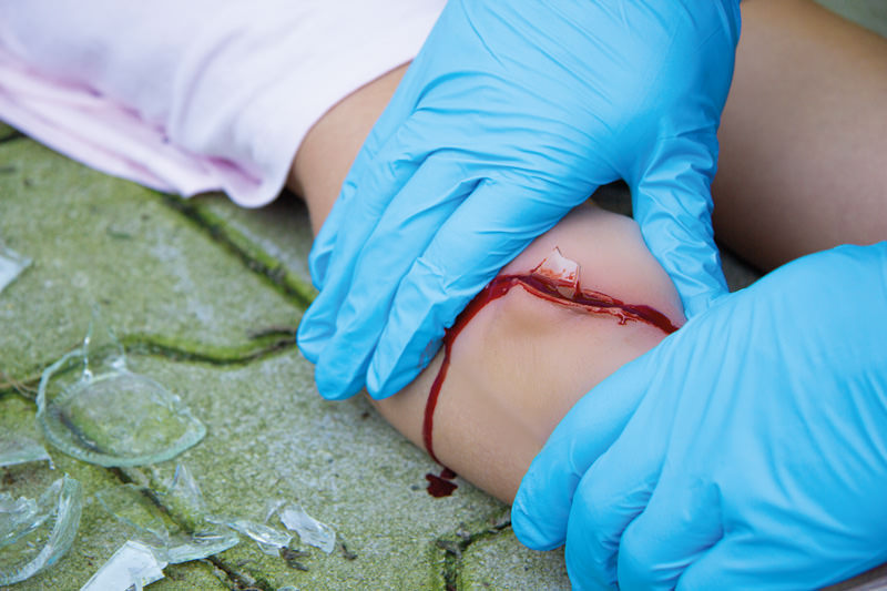 Sårmoulage - Kutt med glass - 6