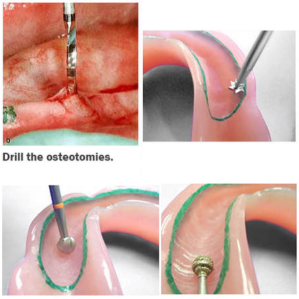 Dentatus Borr Set - 2