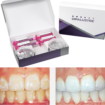 OPALUSTRE® Kit 2x1.2ml