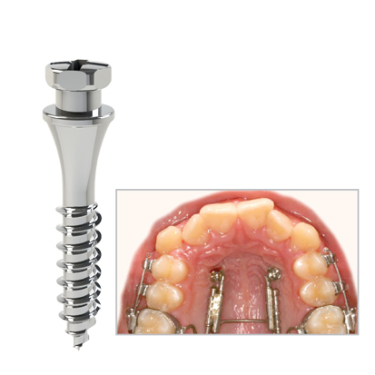Dual Top Mini Screw JS, 1St.