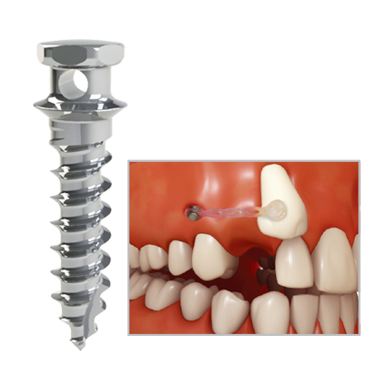 Dual Top Mini Screw JF, 1St.