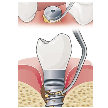 Satelec implant protect Kit