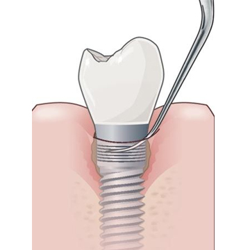 Satelec implant protect Kit - 3