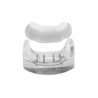 3M® MDI Mini implantat modell