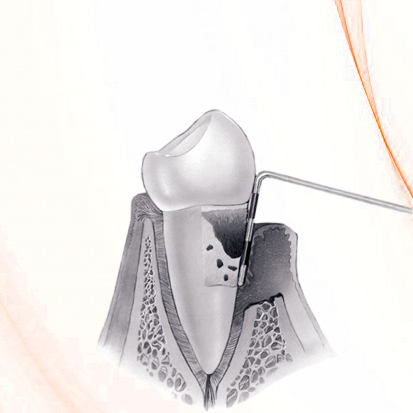 Periodontal