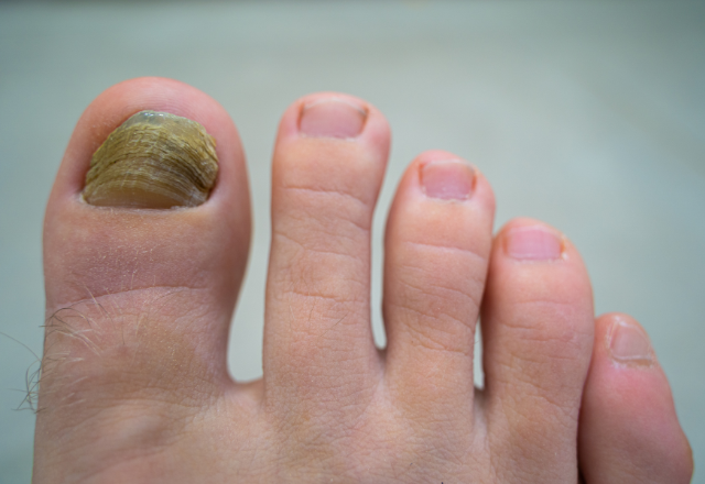 Nagelsvamp Bilder - Exempel på nagelsvamp