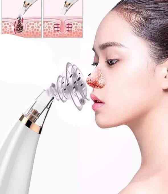 Electrical blackhead remover - 2