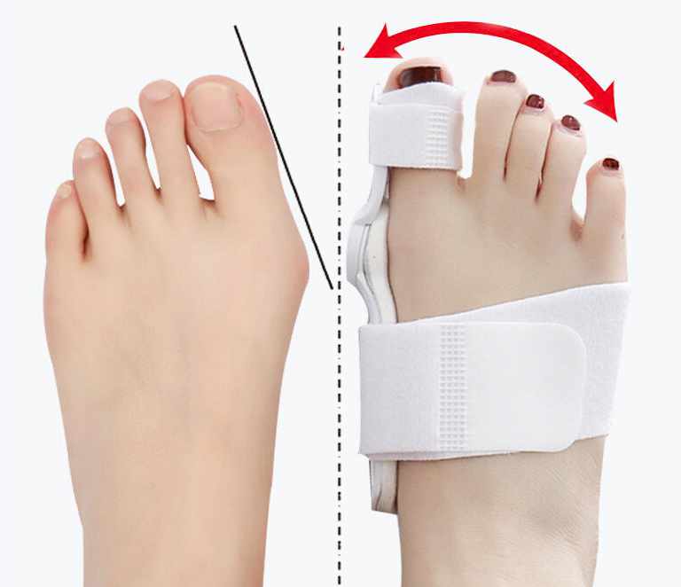 Hallux Valgus - Support Rail Three Colors - 4