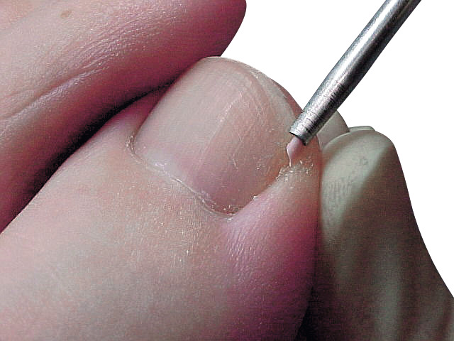 Sulci protektorer, vita (100 st) - 2