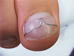 RUCK® Nagelkorrigering ROSS-FRASER Rundtråd, tjocklek 0,5 mm